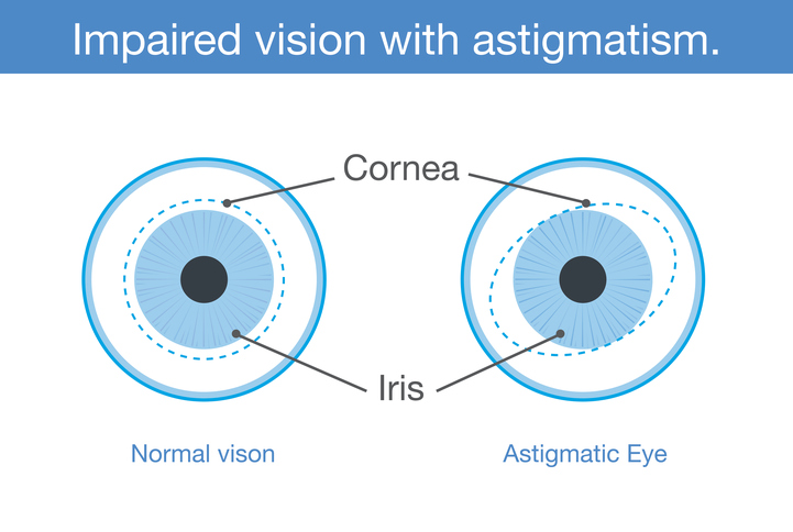 astigmatism