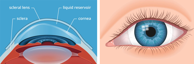 scleral contact lenses, keratoconus