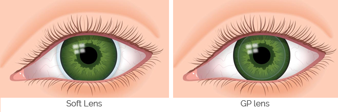 GP Lens, GP Lenses, Gas Permeable Lenses, rigid lenses, rigid contact lenses, Keratoconus